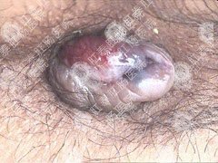 包皮過(guò)長(zhǎng)會(huì)自己好嗎?