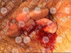 大便出血的癥狀